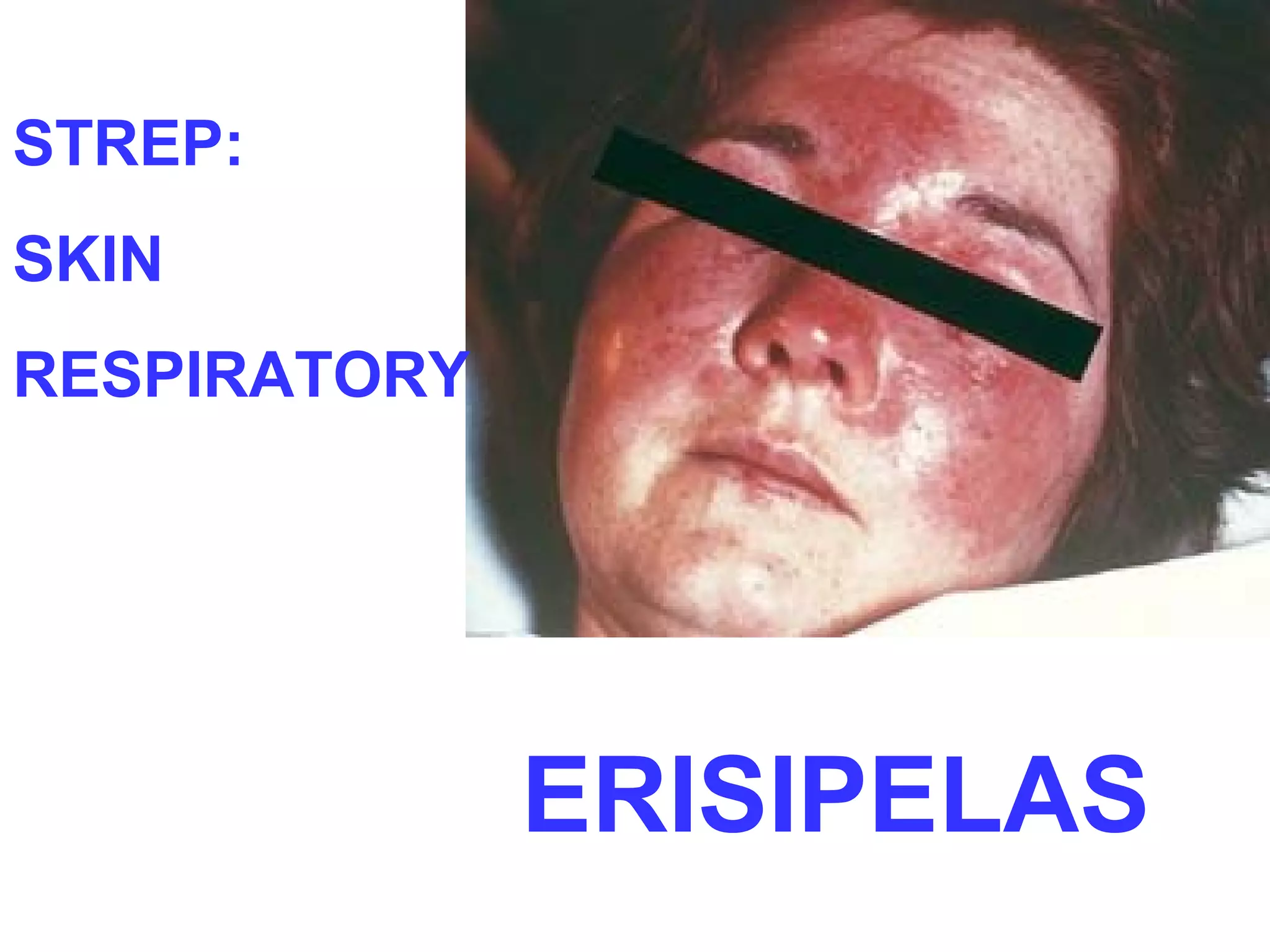 STREP: 
SKIN 
RESPIRATORY 
ERISIPELAS 
 