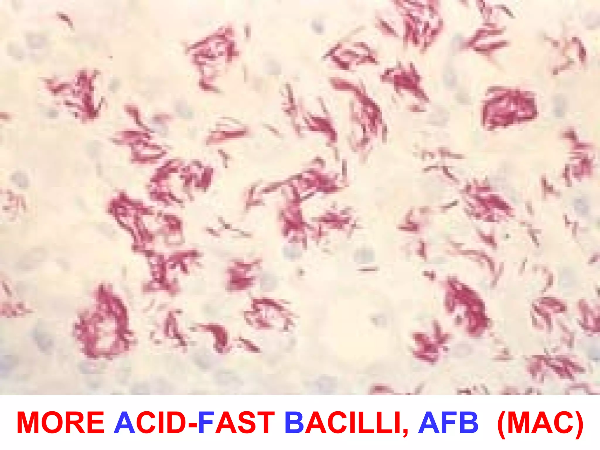 MORE ACID-FAST BACILLI, AFB (MAC) 
 