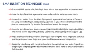 --6-Grasp the LMA by the tube, holding it like a pen as near as possible to the mask end
--7-Place the Tip of the LMA against the inner surface of the patient’s upper teeth
--8-Under direct vision, Press the Mask Tip upwards against the hard palate to flatten it
out using the index finger, keep pressing upwards as you advance the Mask into the
pharynx to ensure the Tip remains flattened and avoids the tongue
--9-Keep the neck Flexed and Head extended (SNIFFING POSITION) the longitudinal black
line should always be pointing directly Cephalad (i.e Facing the patient’s upper Lip)
-10-Press the Mask into the posterior pharyngeal wall using the index finger and continue
pushing with your index finger and guide the Mask downwards into position
-11-Grasp the tube firmly with the other hand and then withdraw your index finger from
the pharynx and press gently downwards with your other hand to ensure the Mask is
fully inserted
-LMA INSERTION TECHNIQUE contd.
 