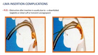 --N.B:- Obstruction after insertion is usually due to – a downfolded
Epiglottis or distal cuff or transient Laryngospasm
-LMA INSERTION COMPLICATIONS
 