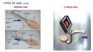 -PROSEAL LMA
-TYPES OF LMA contd.
-C TRACH LMA
 
