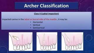 8-Maxillary impaction.pdfcjsncjnkxcmkmkmxkc | PDF