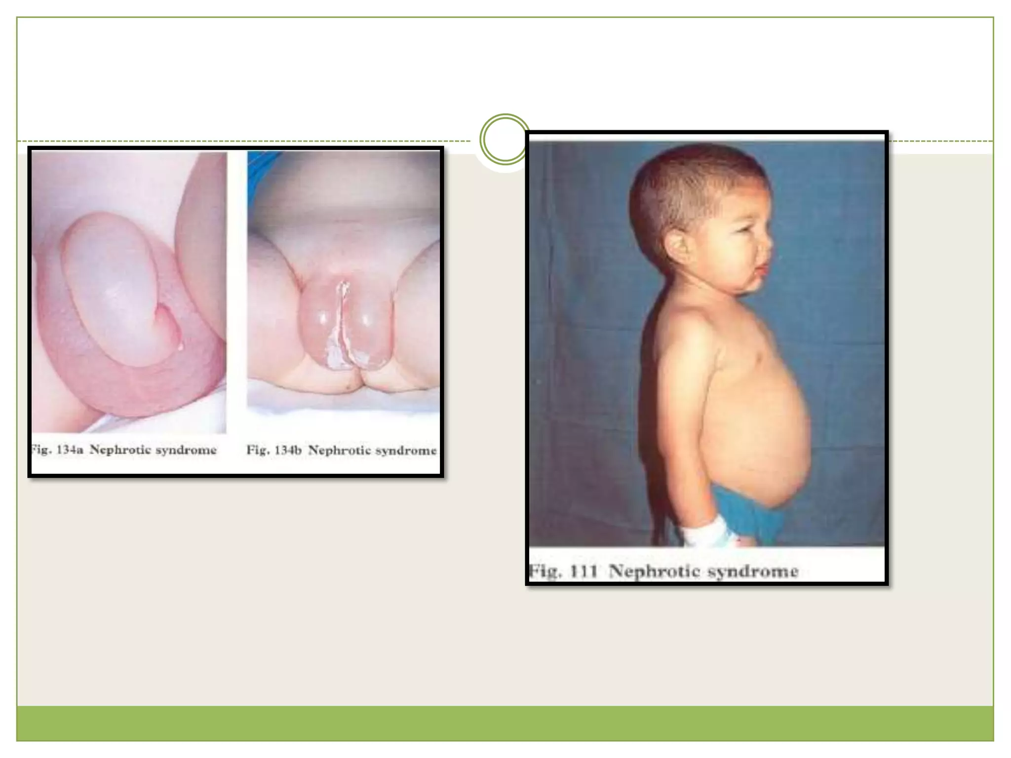  Features:age between 1 and 10 years no macroscopic haematuria normal blood pressure normal complement levels normal renal function. 