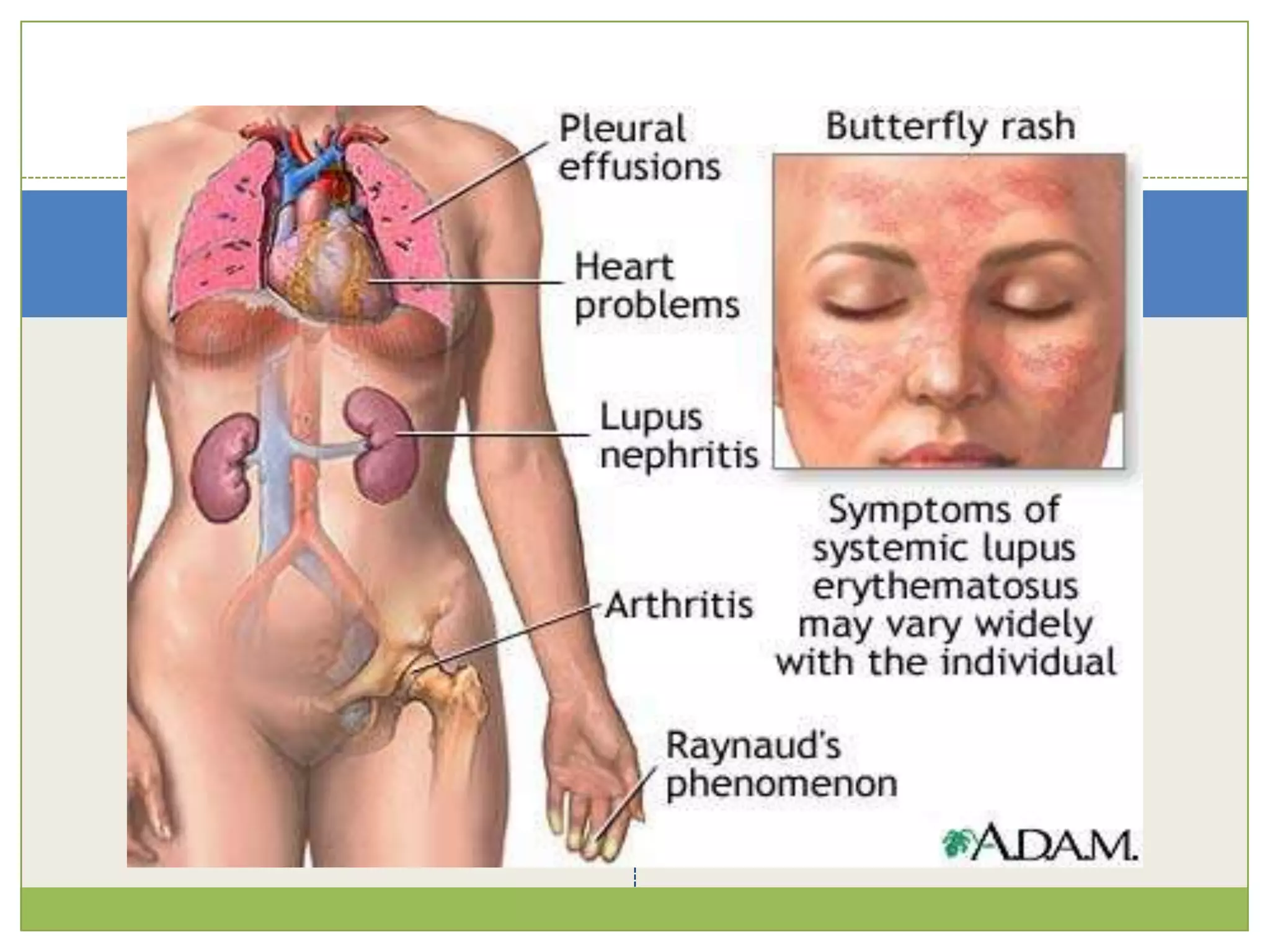 Prednisolone regime for relapses: