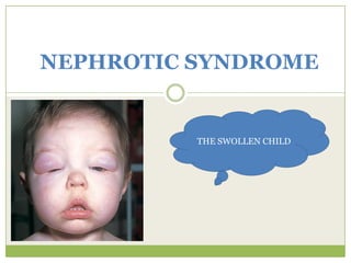 NEPHROTIC SYNDROME THE SWOLLEN CHILD 