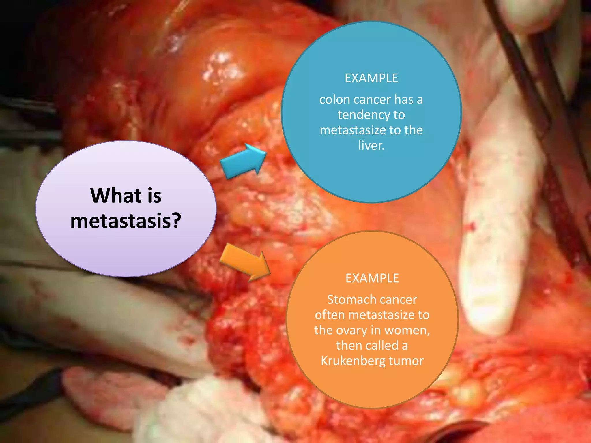 EXAMPLE
              colon cancer has a
                 tendency to
              metastasize to the
                     liver.


 What is
metastasis?

                   EXAMPLE
                Stomach cancer
              often metastasize to
              the ovary in women,
                  then called a
               Krukenberg tumor
 