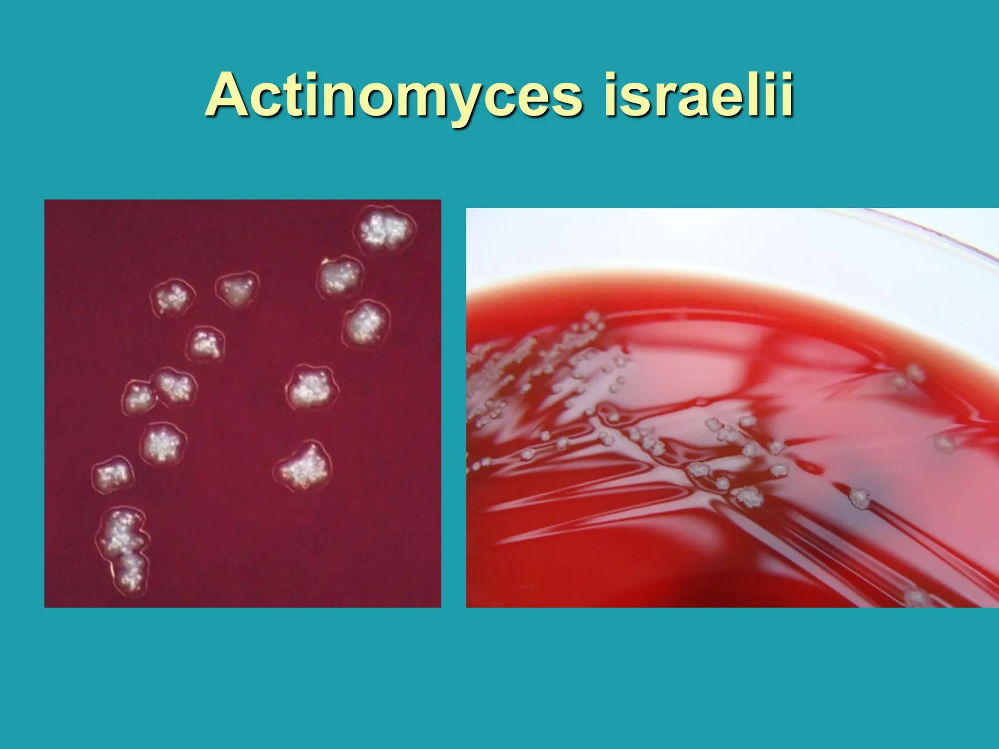 Actinomyces israelii
 