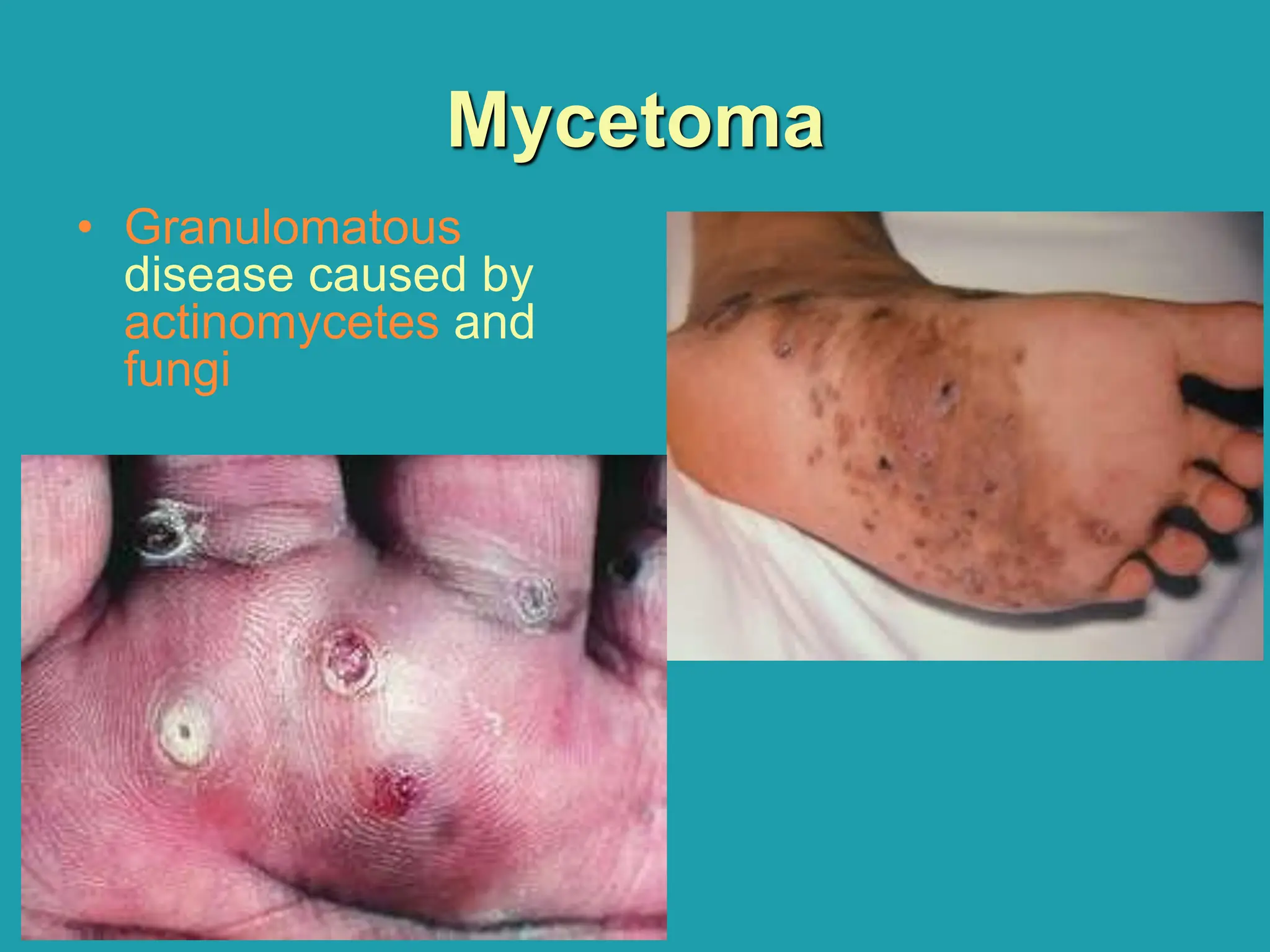 Mycetoma
• Granulomatous
disease caused by
actinomycetes and
fungi
 