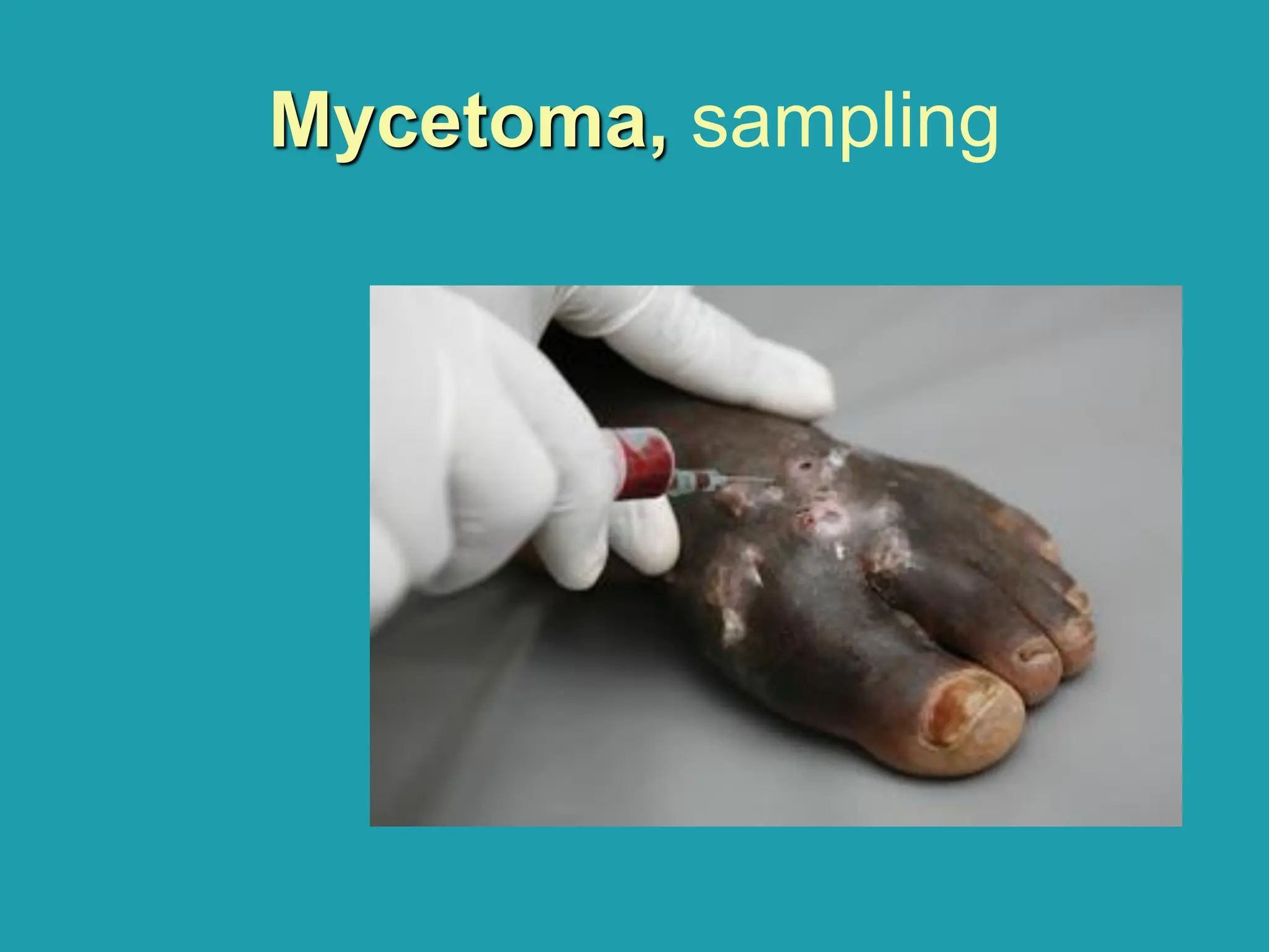 Mycetoma, sampling
 