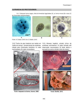 Parasitologia II
443
10.PRANCHA DE PROTOZOÁRIOS
10.1) Trofozoíto forma magna, cheia de hemácias fagocitadas (A), ou forma minuta (B) e cisto (C)
de Entamoeba histolytica/dispar:
A B C
Fonte: A. Cristian, 2010; B e C. Ghaffar, 2010.
10.2) Trecho de alça intestinal com lesões em
“botão de camisa”, características de amebíase,
infeção pela Entamoeba histolytica: A) visão
macroscópica; B) visão microscópica.
Fonte: Adaptado de Santos, Soares, 2008.
10.3) Abcesso hepático, achado clínico da
amebíase extrintestinal: A) lesão fechada sob
observação macroscópica; B) lesão aberta e
secreção purulenta retirada (tubo de ensaio).
Fonte: Ghaffar, 2010.
 