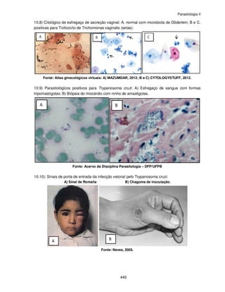 Parasitologia II
445
10.8) Citológico de esfregaço de secreção vaginal: A. normal com microbiota de Döderlein; B e C.
positivas para Trofozoíto de Trichomonas vaginalis (setas):
Fonte: Atlas ginecológicos virtuais: A) MAZUMDAR, 2012; B e C) CYTOLOGYSTUFF, 2012.
10.9) Parasitológicos positivos para Trypanosoma cruzi: A) Esfregaço de sangue com formas
tripomastígotas; B) Biópsia do miocárdio com ninho de amastigotas.
Fonte: Acervo da Disciplina Parasitologia – DFP/UFPB
10.10): Sinais de porta de entrada da infecção vetorial pelo Trypanosoma cruzi:
A) Sinal de Romaña B) Chagoma de inoculação.
Fonte: Neves, 2005.
 