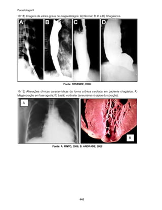 Parasitologia II
446
10.11) Imagens de vários graus de megaesôfagos: A) Normal; B, C e D) Chagásicos.
Fonte: RESENDE, 2009.
10.12) Alterações clínicas características da forma crônica cardíaca em paciente chagásico: A)
Megacoração em fase aguda; B) Lesão vorticelar (aneurisma no ápice do coração).
Fonte: A. PINTO, 2008; B. ANDRADE, 2009
 