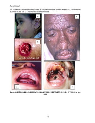 Parasitologia II
448
10.15) Lesões de leishmaniose cutânea: A e B) Leishmaniose cutânea simples; C) Leishmaniose
cutâneo-difusa; D e E) Leishmaniose cutâneo-mucosa.
Fonte: A. CAMPOS, 2010; B. DERMATOLOGIA.NET, 2011; C.BERRUETA, 2011; D e E. VELOSO et AL.,
2006.
 