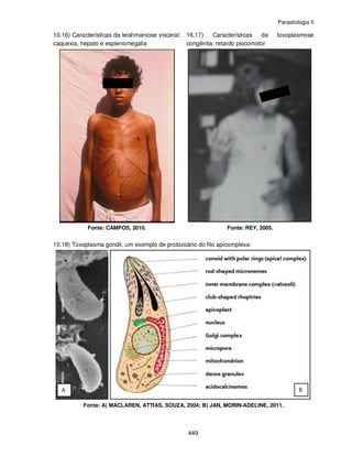 Parasitologia II
449
10.16) Características da leishmaniose visceral:
caquexia, hepato e esplenomegalia
Fonte: CAMPOS, 2010.
16.17) Características da toxoplasmose
congênita: retardo psicomotor
Fonte: REY, 2005.
10.18) Toxoplasma gondii, um exemplo de protozoário do filo apicomplexa:
Fonte: A) MACLAREN, ATTIAS, SOUZA, 2004; B) JAN, MORIN-ADELINE, 2011.
 