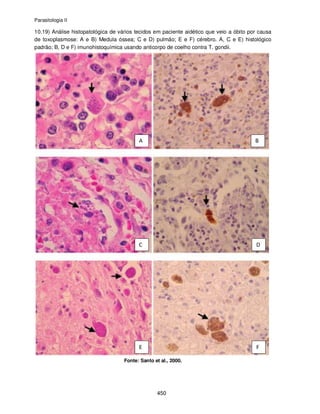 Parasitologia II
450
10.19) Análise histopatológica de vários tecidos em paciente aidético que veio a óbito por causa
de toxoplasmose: A e B) Medula óssea; C e D) pulmão; E e F) cérebro. A, C e E) histológico
padrão; B, D e F) imunohistoquímica usando anticorpo de coelho contra T. gondii.
Fonte: Santo et al., 2000.
 