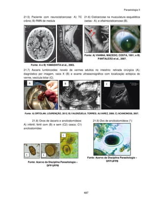 Parasitologia II
487
21.5) Paciente com neurocisticercose: A) TC
crânio; B) RMN de medula
Fonte: A e B) YAMASHITA et al., 2003.
21.6) Cisticercose na musculatura esquelética
(setas - A); e oftalmocisticercose (B).
Fonte: A) VIANNA; MACEDO; COSTA, 1991; e B)
PANTALEÃO et al., 2007.
21.7) Ascaris lumbricoides: novelo de vermes adultos no intestino: retirada cirúrgica (A);
diagnóstico por imagem, raios X (B) e exame ultrassonográfico com localização ectópica do
verme, vesícula biliar (C).
Fonte: A) ORTOLAN; LOURENÇÃO, 2012; B) VALENZUELA; TORRES; ALVAREZ, 2008; C) ACANCINO58, 2007.
21.8) Ovos de áscaris e ancilostomídeos:
A) infértil; fértil com (B) e sem (C2) casca; C1)
ancilostomídeo
Fonte: Acervo da Disciplina Parasitologia –
DFP/UFPB
21.9) Ovo de ancilostomídeos (*):
Fonte: Acervo da Disciplina Parasitologia –
DFP/UFPB
 