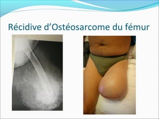 Récidive d’Ostéosarcome du fémur
 