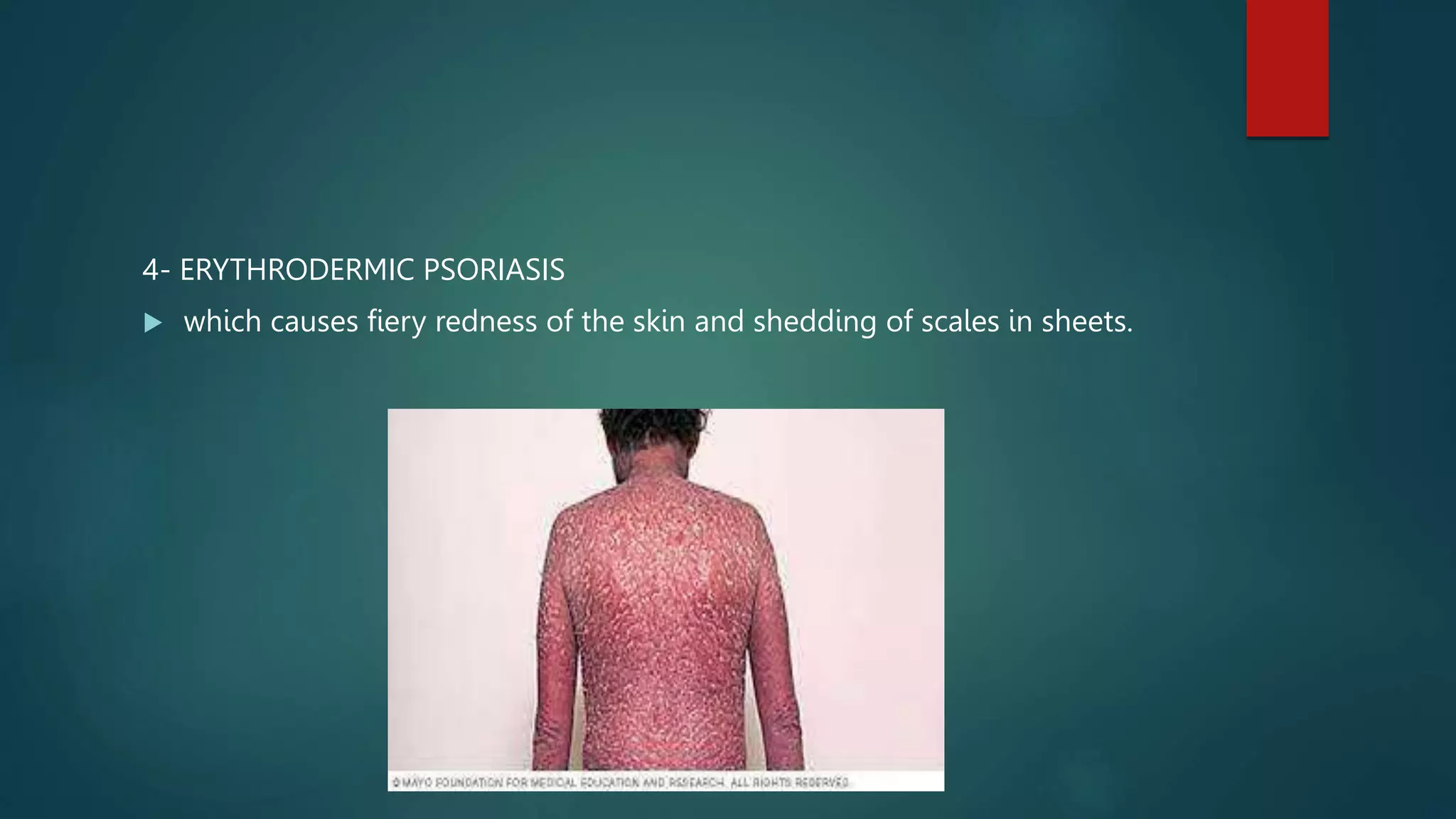 Image showcasing 8- Psoriasis.pptx