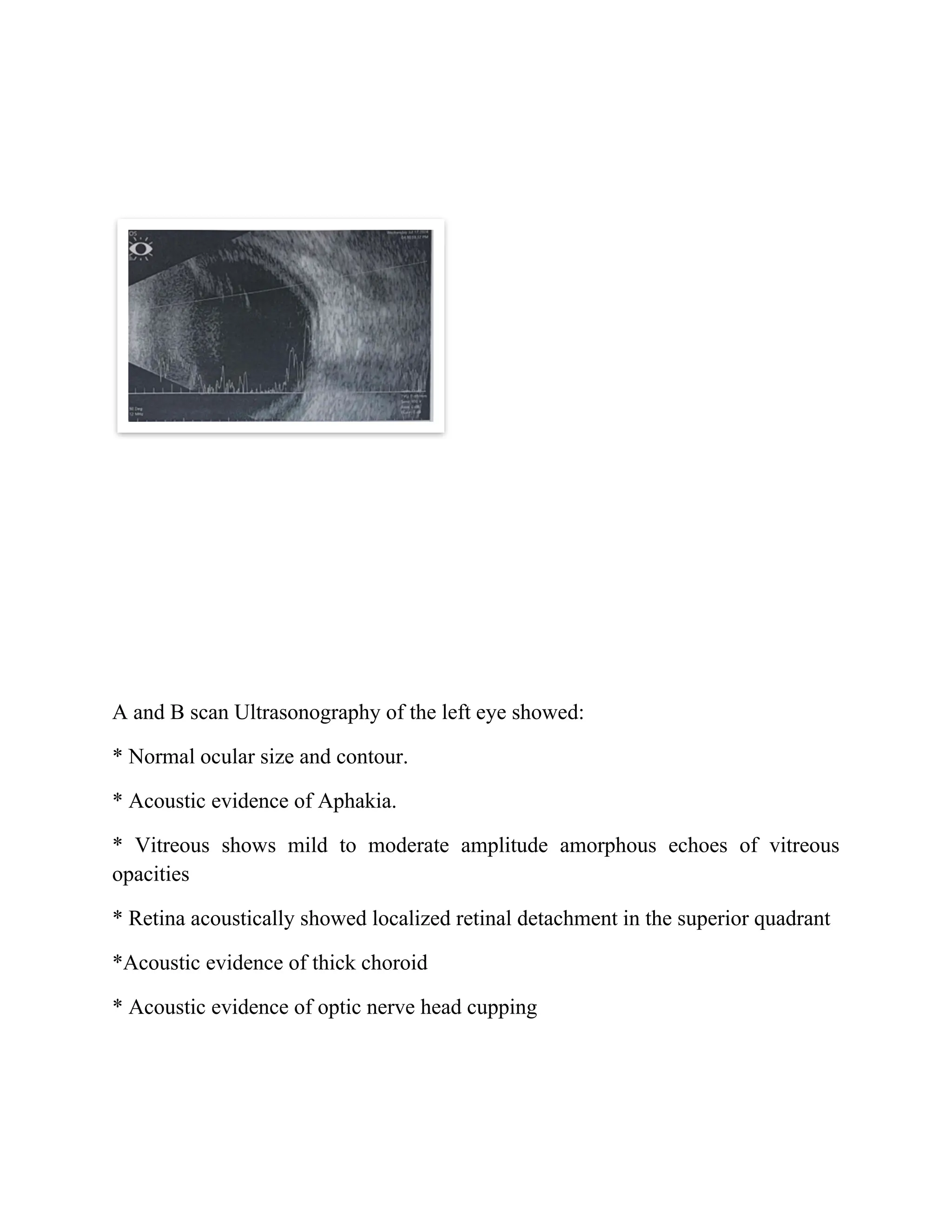 A and B scan Ultrasonography of the left eye showed:
* Normal ocular size and contour.
* Acoustic evidence of Aphakia.
* Vitreous shows mild to moderate amplitude amorphous echoes of vitreous
opacities
* Retina acoustically showed localized retinal detachment in the superior quadrant
*Acoustic evidence of thick choroid
* Acoustic evidence of optic nerve head cupping
 