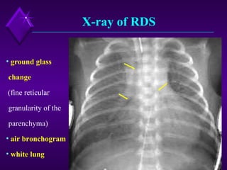 Optic Cloth Rds Respiratory Distress Syndrome (Rds) | PPT