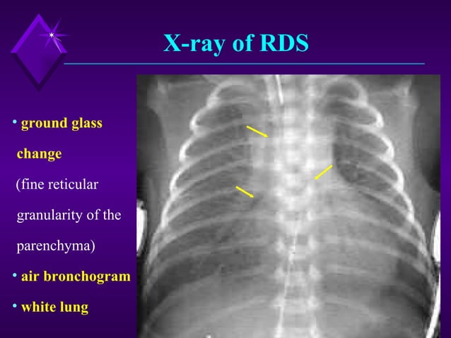 Respiratory Distress Syndrome (Rds) | PPT