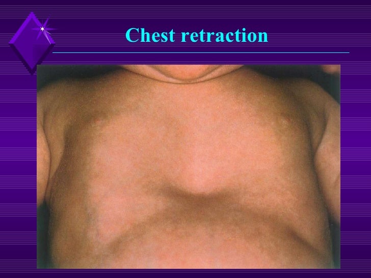 Respiratory Distress Syndrome (Rds)