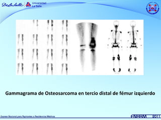 Gammagrama de Osteosarcoma en tercio distal de fémur izquierdo
 