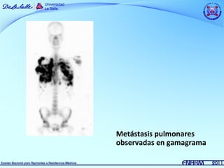 Metástasis pulmonares
observadas en gamagrama
 