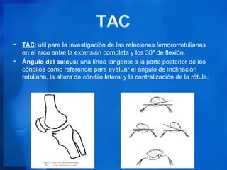 • TAC: útil para la investigación de las relaciones femororrotulianas
  en el arco entre la extensión completa y los 30ª de flexión.
• Ángulo del sulcus: una línea tangente a la parte posterior de los
  cóndilos como referencia para evaluar el ángulo de inclinación
  rotuliana, la altura de cóndilo lateral y la centralización de la rótula.
 