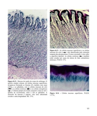 121
Figura 8.12 - Mucosa da região do corpo do estômago. O
epitélio simples colunar, de células mucosas superficiais,
invagina-se formando as fossetas (F), também com essas
células, e as glândulas, com as células mucosas do colo
( ), as células oxínticas ( ) e as células zimogênicas
( ). A lâmina própria de tecido conjuntivo situa-se sob o
epitélio de revestimento, entre e sob as glândulas. A
muscular da mucosa é espessa, com uma subcamada
circular e outra longitudinal. HE. 137x.
Figura 8.13 - As células mucosas superficiais e as células
mucosas do colo ( ) são identificadas pela coloração
magenta das glicoproteínas. O muco secretado é visto sobre
a superfície epitelial. As células oxínticas ( ) também
estão coradas por causa da síntese do fator antianêmico
intrínseco. PAS/H. 137x.
Figura 8.14 - Células mucosas superficiais. PAS/H.
1.373x.
 