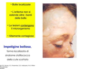 • Bolle localizzate

                 • L’eritema non si
                estende oltre i bordi
                     della bolla

            • Le lesioni contengono
                il microrganismo

            • Altamente contagiose



      Impetigine bollosa,
           forma localizzata di
         sindrome stafilococca
           della cute scottata

da P.R. Murray, K.S. Rosenthal, G.S. Kobayashi, M.A. Pfaller
Microbiologia
EDISES
 