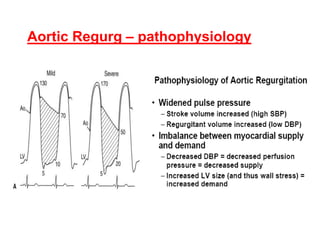 8- Valvular_heart_disease DR. Nouradden Al-Jaber.ppt