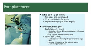 Axillary Clips Comprehensive Overview of Esophageal Atresia: History, Embryology ...
