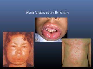 Edema Angioneurótico Hereditário
 