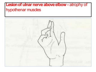 Lesionof ulnar nerveaboveelbow - atrophy of
hypothenar muscles
 