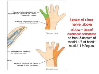 Lesion of ulnar
nerve above
elbow - Lossof
cutaneous sensations
on front &dorsum of
medial 1/3 of hand+
medial 1 ½fingers.
 