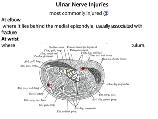 Ulnar Nerve Injuries
most commonly injured @
At elbow
where it lies behind the medial epicondyle usually associated with
fracture
At wrist
where it lies with the ulnar artery in front of the flexor retinaculum.
 