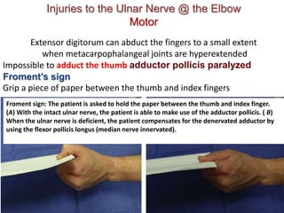 Injuries to the Ulnar Nerve @ the Elbow
Motor
Extensor digitorum can abduct the fingers to a small extent
when metacarpophalangeal joints are hyperextended
Impossible to adduct the thumb adductor pollicis paralyzed
Froment’s sign
Grip a piece of paper between the thumb and index fingers
Froment sign: The patient is asked to hold the paper between the thumb and index finger.
(A) With the intact ulnar nerve, the patient is able to make use of the adductor pollicis. ( B)
When the ulnar nerve is deficient, the patient compensates for the denervated adductor by
using the flexor pollicis longus (median nerve innervated).
 