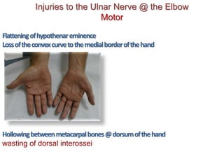 Injuries to the Ulnar Nerve @ the Elbow
Motor
Flatteningofhypothenareminence
Lossoftheconvexcurvetothemedialborderofthehand
Hollowingbetweenmetacarpalbones@dorsumofthehand
wasting of dorsal interossei
 