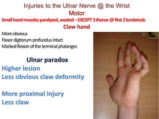 Injuries to the Ulnar Nerve @ the Wrist
Motor
Smallhandmusclesparalyzed,wasted–EXCEPT3thenar@first2lumbricals
Claw hand
Moreobvious
Flexordigitorumprofundusintact
Markedflexionoftheterminalphalanges
Ulnar paradox
Higher lesion
Less obvious claw deformity
More proximal injury
Less claw
 