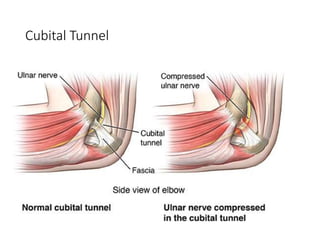 Cubital Tunnel
 