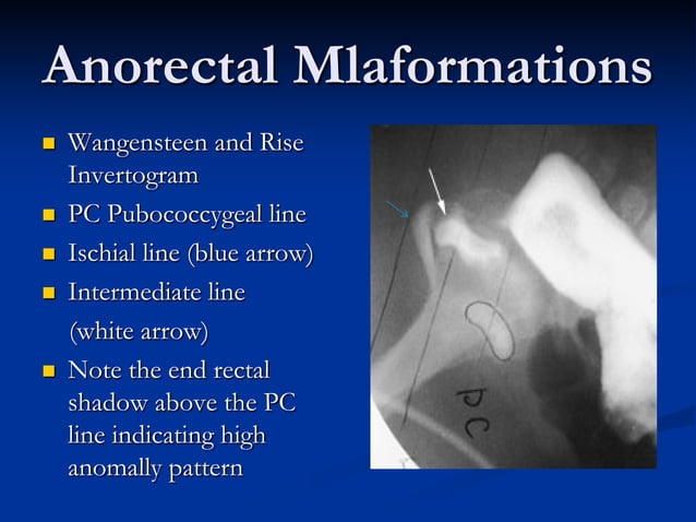 case study on anorectal malformation slideshare