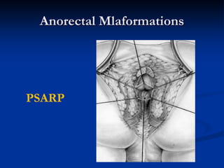 anorectal malformation | PDF