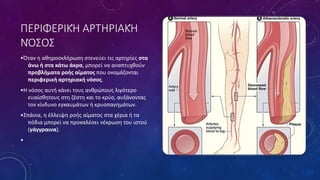 ΠΕΡΙΦΕΡΙΚΉ ΑΡΤΗΡΙΑΚΉ
ΝΌΣΟΣ
•Όταν η αθηροσκλήρωση στενεύει τις αρτηρίες στα
άνω ή στα κάτω άκρα, μπορεί να αναπτυχθούν
προβλήματα ροής αίματος που ονομάζονται
περιφερική αρτηριακή νόσος.
•Η νόσος αυτή κάνει τους ανθρώπους λιγότερο
ευαίσθητους στη ζέστη και το κρύο, αυξάνοντας
τον κίνδυνο εγκαυμάτων ή κρυοπαγημάτων.
•Σπάνια, η έλλειψη ροής αίματος στα χέρια ή τα
πόδια μπορεί να προκαλέσει νέκρωση του ιστού
(γάγγραινα).
•
 