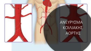 ΑΝΕYΡΥΣΜΑ
ΚΟΙΛΙΑΚHΣ
ΑΟΡΤHΣ
 