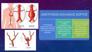 ΑΝΕΥΡΥΣΜΑ ΚΟΙΛΙΑΚΗΣ ΑΟΡΤΗΣ
Το αρτηριακό
ανεύρυσµα είναι µια
παθολογική διάταση
του τοιχώµατος της
αρτηρίας.
Τα ανευρύσµατα
συνήθως
εντοπίζονται στην
κοιλιακή αορτή, αλλά
η νόσος µπορεί να
εµφανιστεί και σε
άλλα τµήµατα της
αορτής.
Η αορτή στην ρίζα της
ξεκινάει με διάμετρο
περίπου 31 mm
ενώ ανεύρυσμα
κοιλιακής αορτής
θεωρείται όταν η
διάμετρος αορτής
είναι >3 cm.
 
