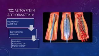 ΠΏΣ ΛΕΙΤΟΥΡΓΕΙ Η
ΑΓΓΕΙΟΠΛΑΣΤΙΚΗ;
ΕΙΣΕΡΧΕΤΑΙ Ο
ΚΑΘΕΤΗΡΑΣ
ΦΟΥΣΚΩΝΕΙ ΤΟ
ΜΠΑΛΟΝΙ
ΒΓΑΙΝΕΙ Ο
ΚΑΘΕΤΗΡΑΣ ΚΑΙ
ΜΕΝΕΙ ΤΟ STENT
 