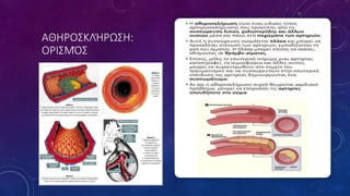ΑΘΗΡΟΣΚΛΉΡΩΣΗ:
ΟΡΙΣΜΌΣ
 