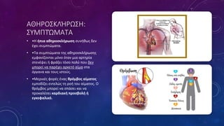 ΑΘΗΡΟΣΚΛΉΡΩΣΗ:
ΣΥΜΠΤΏΜΑΤΑ
• •Η ήπια αθηροσκλήρωση συνήθως δεν
έχει συμπτώματα.
• •Τα συμπτώματα της αθηροσκλήρωσης
εμφανίζονται μόνο όταν μια αρτηρία
στενέψει ή φράξει τόσο πολύ που δεν
μπορεί να παρέχει αρκετό αίμα στα
όργανα και τους ιστούς.
• •Μερικές φορές ένας θρόμβος αίματος
εμποδίζει εντελώς τη ροή του αίματος. Ο
θρόμβος μπορεί να σπάσει και να
προκαλέσει καρδιακή προσβολή ή
εγκεφαλικό.
 