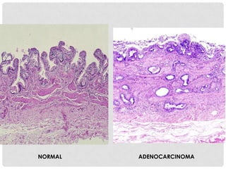 NORMAL   ADENOCARCINOMA
 
